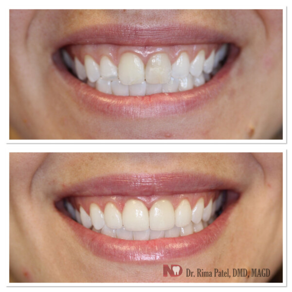 Restoration of Chipped Tooth